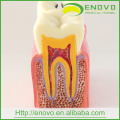 Modèle de dents pathologiques dentaires EN-M2 de 6Ttimes Caries Comparation